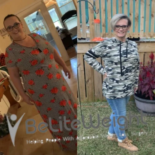 Weight Loss Surgery Gastric Sleeve before and after
